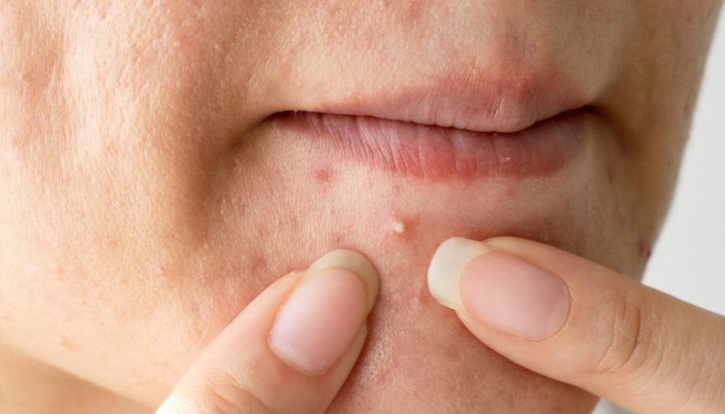 Dermatologista indica 2 alimentos para quem quer eliminar acne (e 2 que pioram)