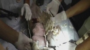 Bebê teve de ser levado para hospital dentro de cano 