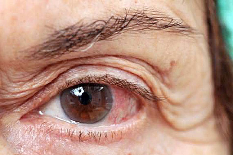 26 de Maio - Dia Nacional de Combate ao Glaucoma Foto: Ilustração