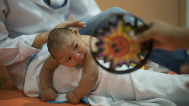Bebê com microcefalia no Recife; casos notificados passam de 4 mil 