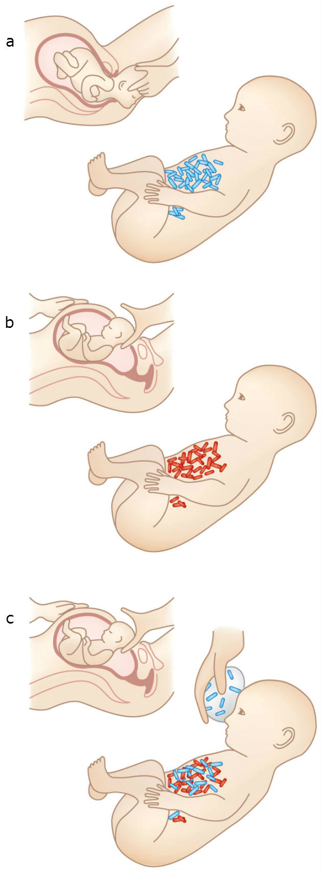 Fluido vaginal da mãe em bebê nascido de cesárea poderia preveni-lo de doenças