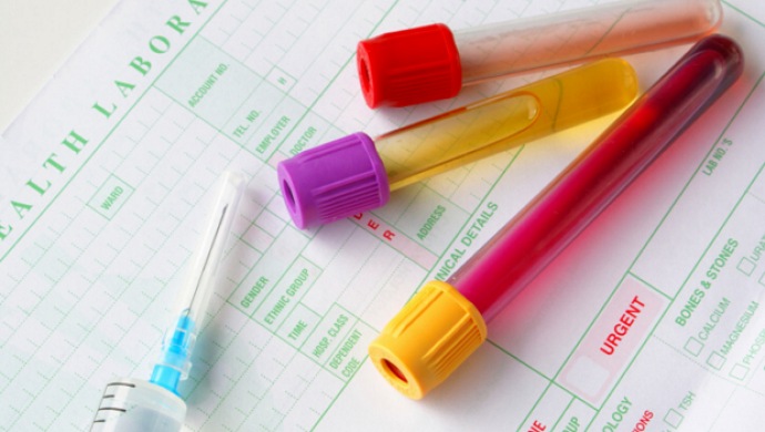 Teste de urina poderia detectar câncer no pâncreas