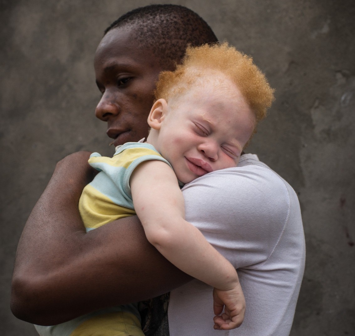 Desafios dos albinos incluem exclusão social.