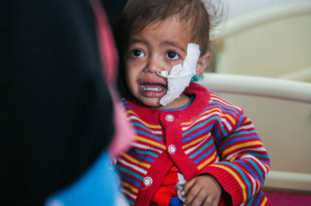 Meio milhão de crianças sofrem de desnutrição aguda grave devido à guerra no país mais pobre do Oriente Médio.Foto: Unicef