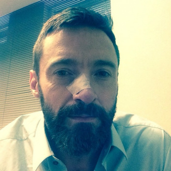 Ator de Wolverine, Hugh Jackman faz nova cirurgia para retirar câncer
