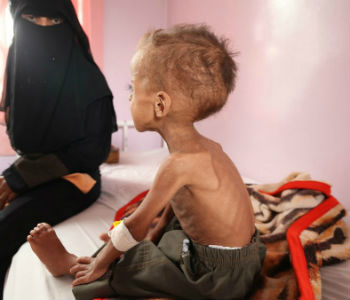 Aumento de crianças desnutridas no Iêmen. Foto: Unicef/Yasin