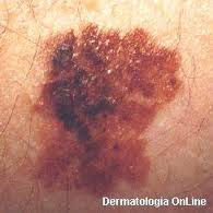 Melanoma: Manchas escuras podem esconder tipo mais agressivo de câncer de pele