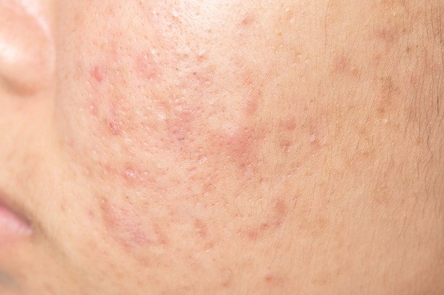 A acne não tratada pode deixar a pele com manchas e marcas, além dos cravos e espinhas (srisakorn/Thinkstock)
