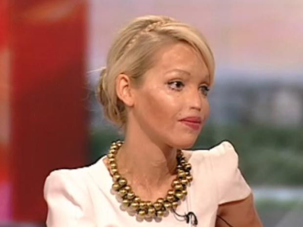 Modelo desfigurada pelo ex com ácido cria fundação para vítimas Katie Piper atualmente. (Foto: BBC)