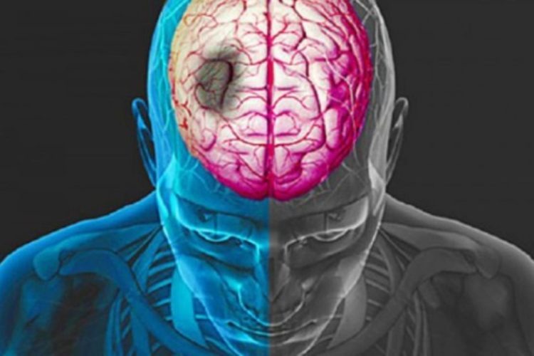 Entenda o que é o Acidente Vascular Cerebral Foto: divulgação