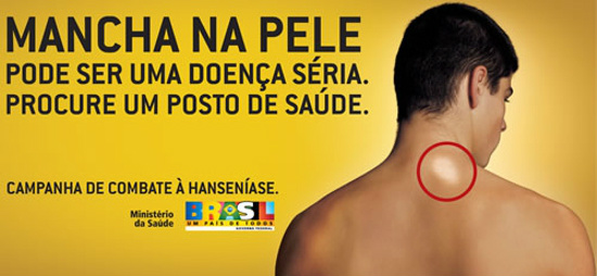 Dia Mundial do Hanseniano - Em 2014, sete casos foram notificados em Amambai
