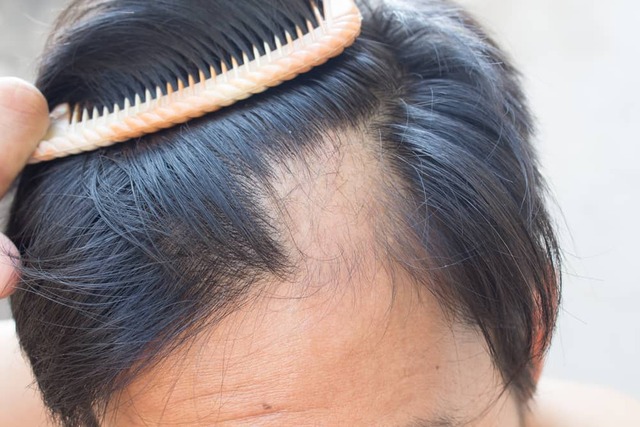 Alopecia Areta atinge barbas, sobrancelhas, bigode, cílios e até pelos do corpo Foto: Ilustração