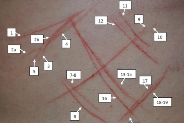 Suástica em jovem foi automutilação ou teve consentimento, diz laudo Suástica em jovem foi automutilação ou teve consentimento, diz laudo