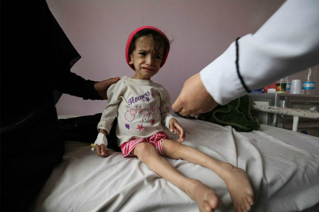 Conflito no Iêmen matou mais de 500 crianças em seis meses Uma criança de 2 anos desnutrida recebe tratamento em um hospital no Iêmen. Foto: Unicef/Yasin