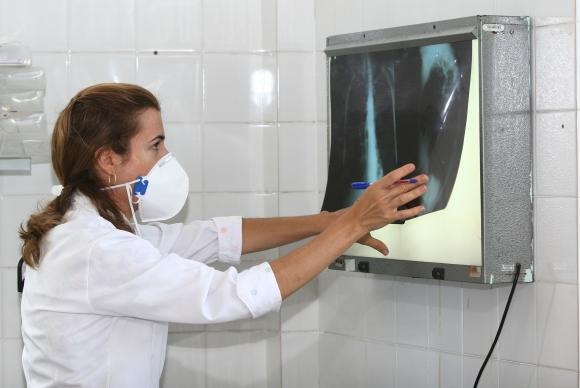 Brasil tem 34% dos casos de coinfecção de tuberculose e HIV do mundo É necessário ficar atento aos sintomas da tuberculose para dar início ao tratamento e, com isso, interromper a contaminação das outras pessoasAgecom Bahia