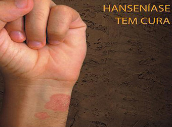 Semana de Combate à Hanseníase iniciou dia 24; em Amambai, será em março Programações para a data em Amambai serão promovidas apenas em março.
