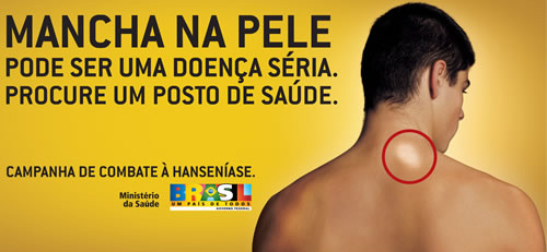 Semana de Combate à Hanseníase iniciou dia 24; em Amambai, será em março Semana de Combate à Hanseníase iniciou dia 24; em Amambai, será em março