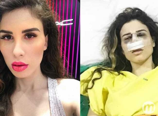 Youtuber brasileira fica sem andar após infecção em prótese de silicone Youtuber brasileira fica sem andar após infecção em prótese de silicone