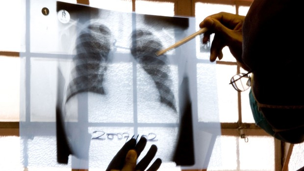 Casos de tuberculose caem pela primeira vez na história, diz OMS