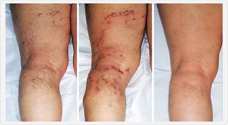Trombose causada por anticoncepcional: sintomas e pílulas mais perigosas Trombose causada por anticoncepcional: sintomas e pílulas mais perigosas