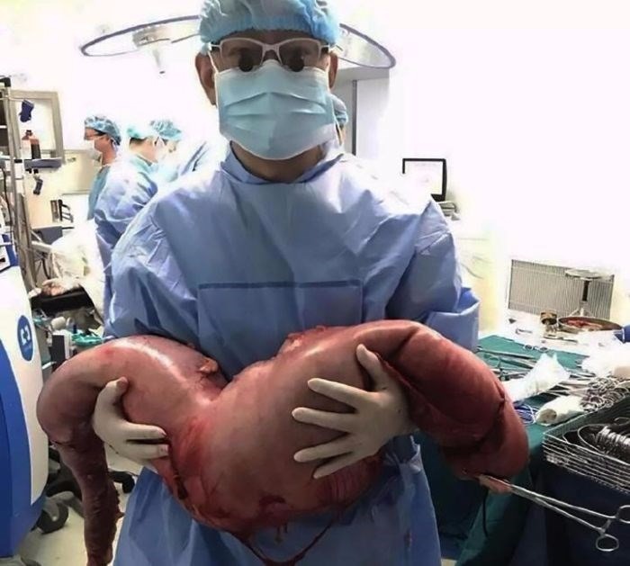 Doutor Yin Lu posa com a parte retirada do intestino do rapaz