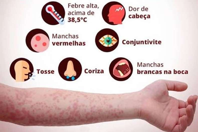 Começa hoje a segunda fase da vacinação contra o sarampo Nos últimos 90 dias de surto ativo, foram confirmados 1.729 casos em pessoas de 20 a 29 anos / Foto: Divulgação