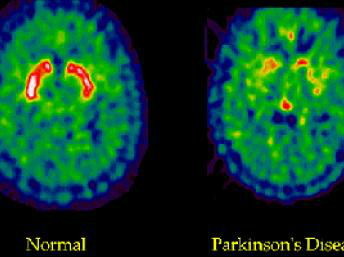 Cérebro atingido por mal de ParkinsonD.R.