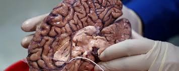 Descobriram uma área oculta dentro do cérebro humano