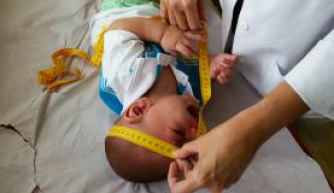 Segundo caso de microcefalia associada ao Zika é registrado nos Estados Unidos Bebê com microcefalia