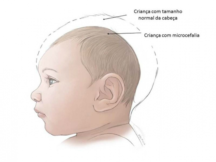 Oito estados do Nordeste e Goiás têm 739 casos suspeitos de microcefalia Oito estados do Nordeste e Goiás têm 739 casos suspeitos de microcefalia