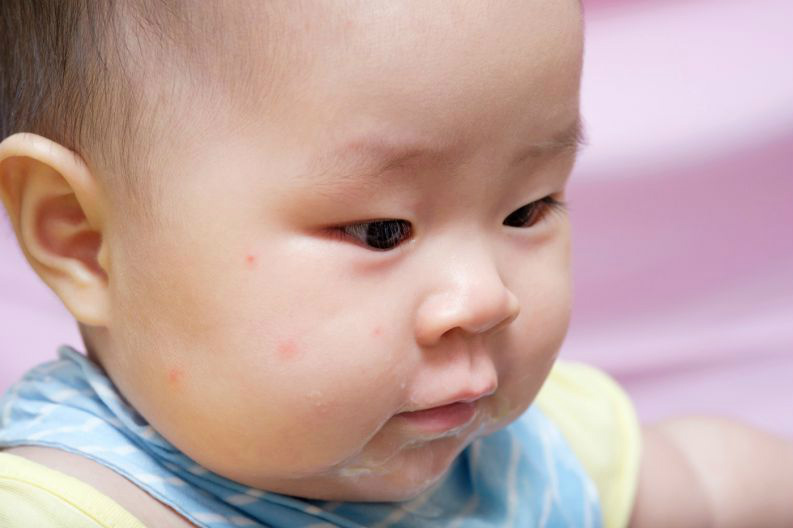 Bebê apareceu com picadinhas de mosquito: o que fazer agora? Pediatra orienta Bebê apareceu com picadinhas de mosquito: o que fazer agora? Pediatra orienta