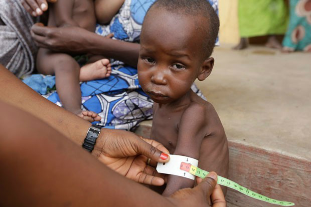 Nigéria: 250 mil crianças têm desnutrição aguda grave Nigéria: 250 mil crianças têm desnutrição aguda grave
