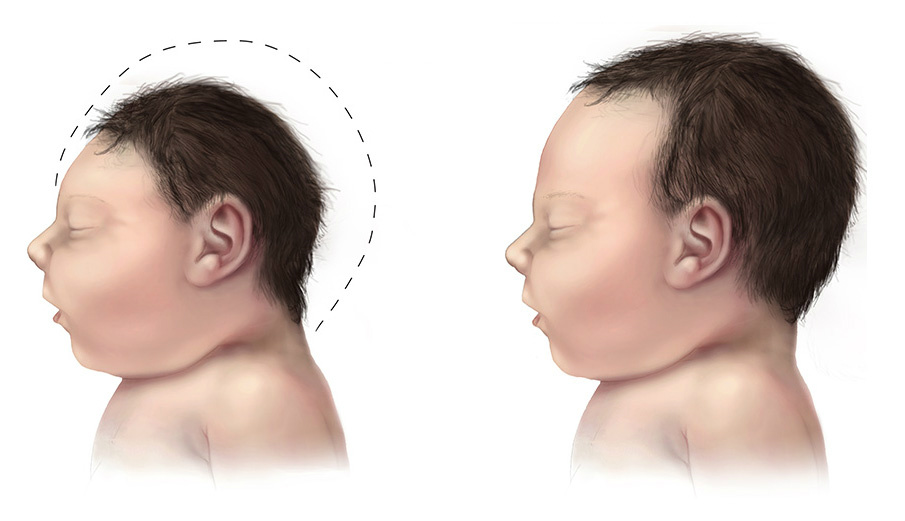 Um bebê com microcefalia (à esquerda) em comparação com um bebê normal